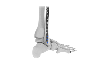 aslp posterior fibula plate