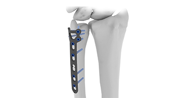 distal ulna plate
