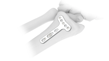 dorsal volar plate aslp