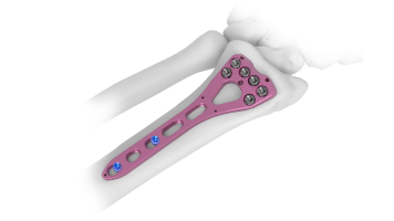 two column volar plate valp